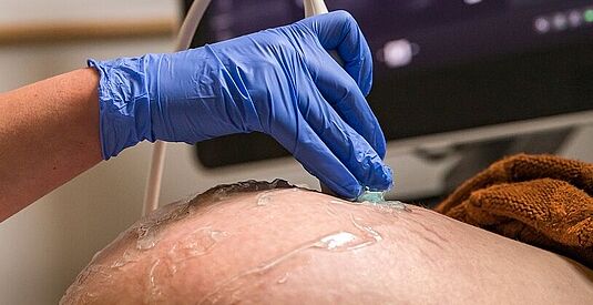 afbeelding Vastzittende placenta