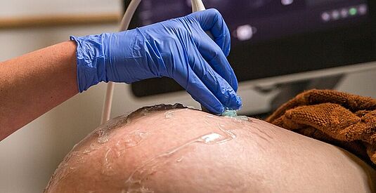 afbeelding Zwangerschapsjeuk